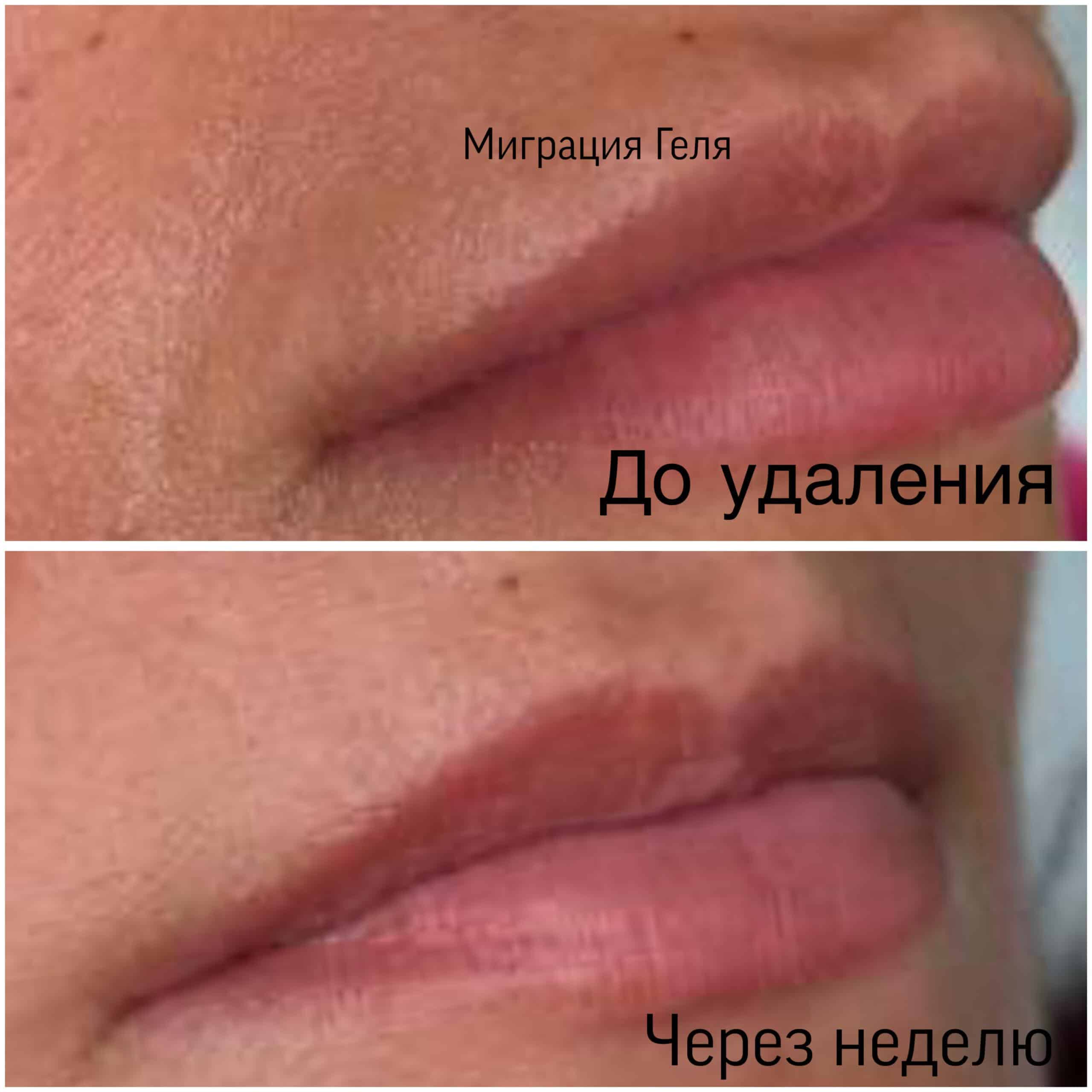Удаление филлера из губ — фото до и после процедуры в клинике ANVI, Москва