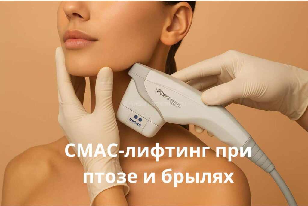 Коррекция брылей с помощью СМАС-лифтинга