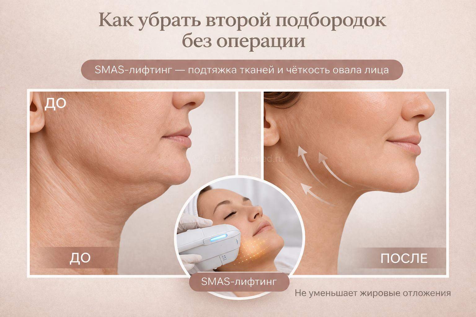 второй подбородок до и после SMAS лифтинга без операции