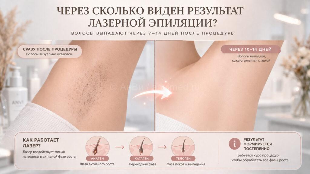 Через сколько виден результат лазерной эпиляции — выпадение волос через 7–14 дней