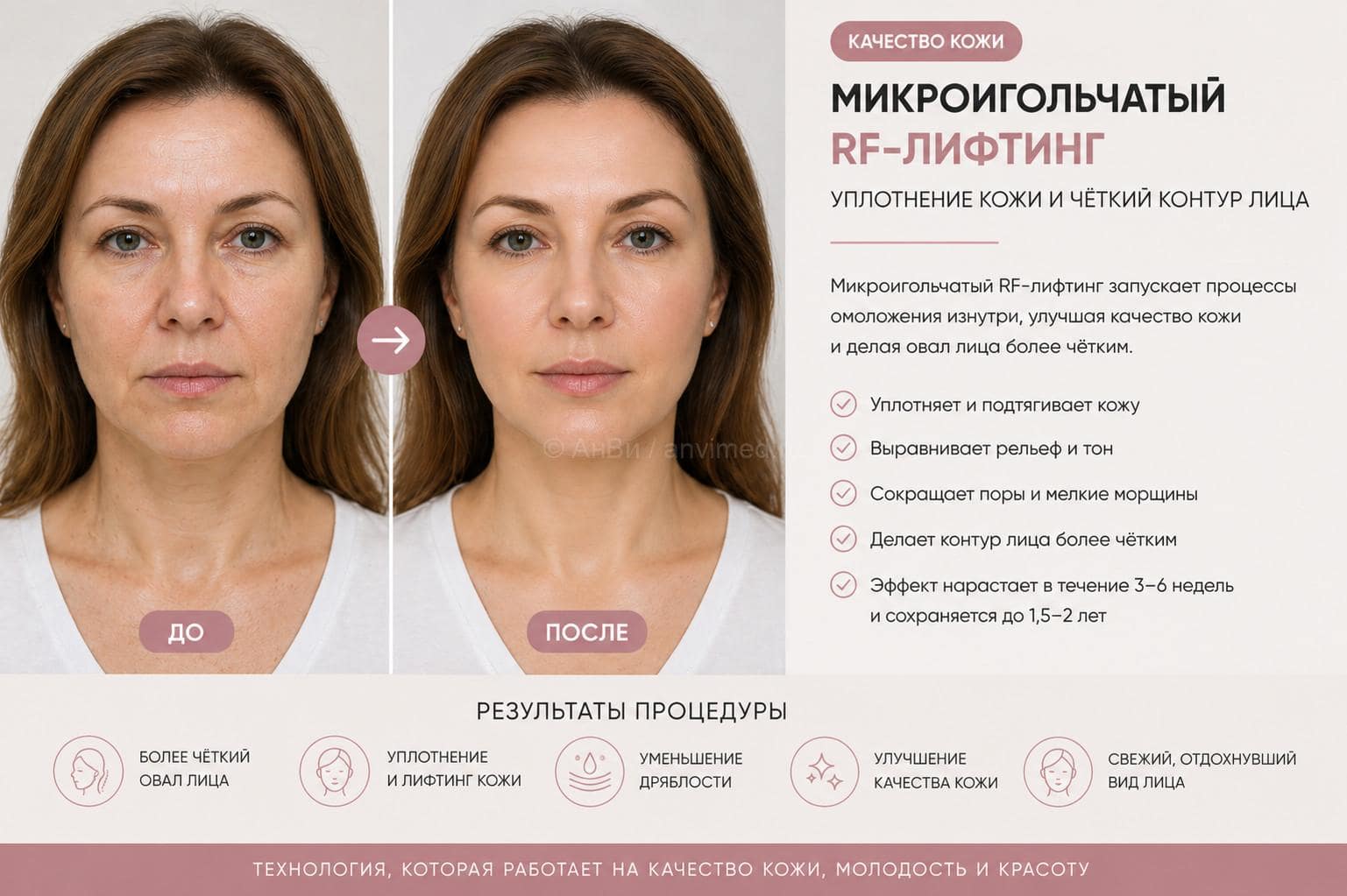 микроигольчатый RF лифтинг лица до и после — как сделать лицо худее и улучшить овал лица