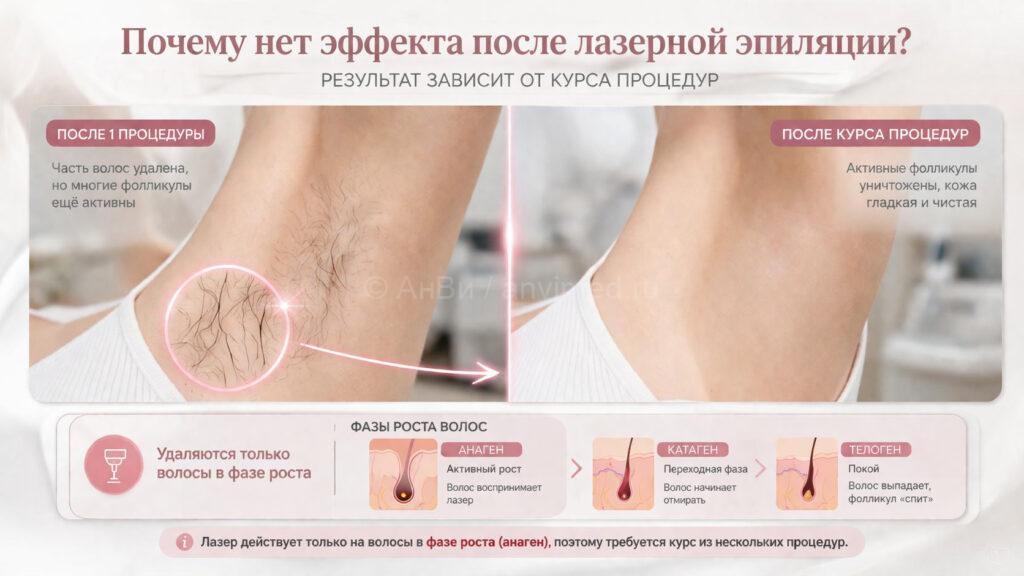 Почему нет эффекта после лазерной эпиляции — причины и что делать