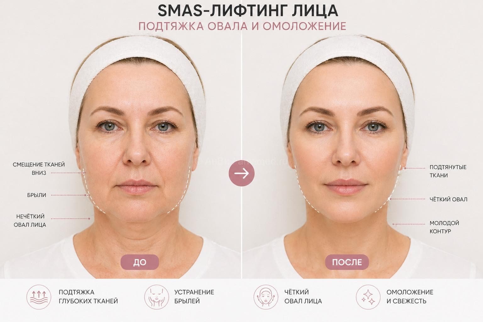 SMAS лифтинг лица до и после — как сделать лицо худее и подтянуть овал лица без операции