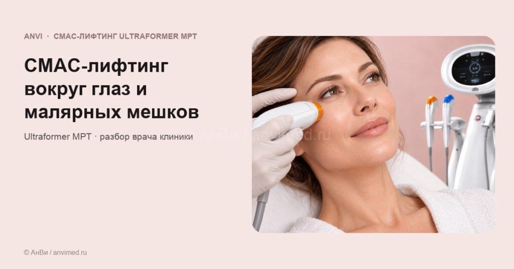 СМАС-лифтинг вокруг глаз и малярных мешков — обложка статьи v2