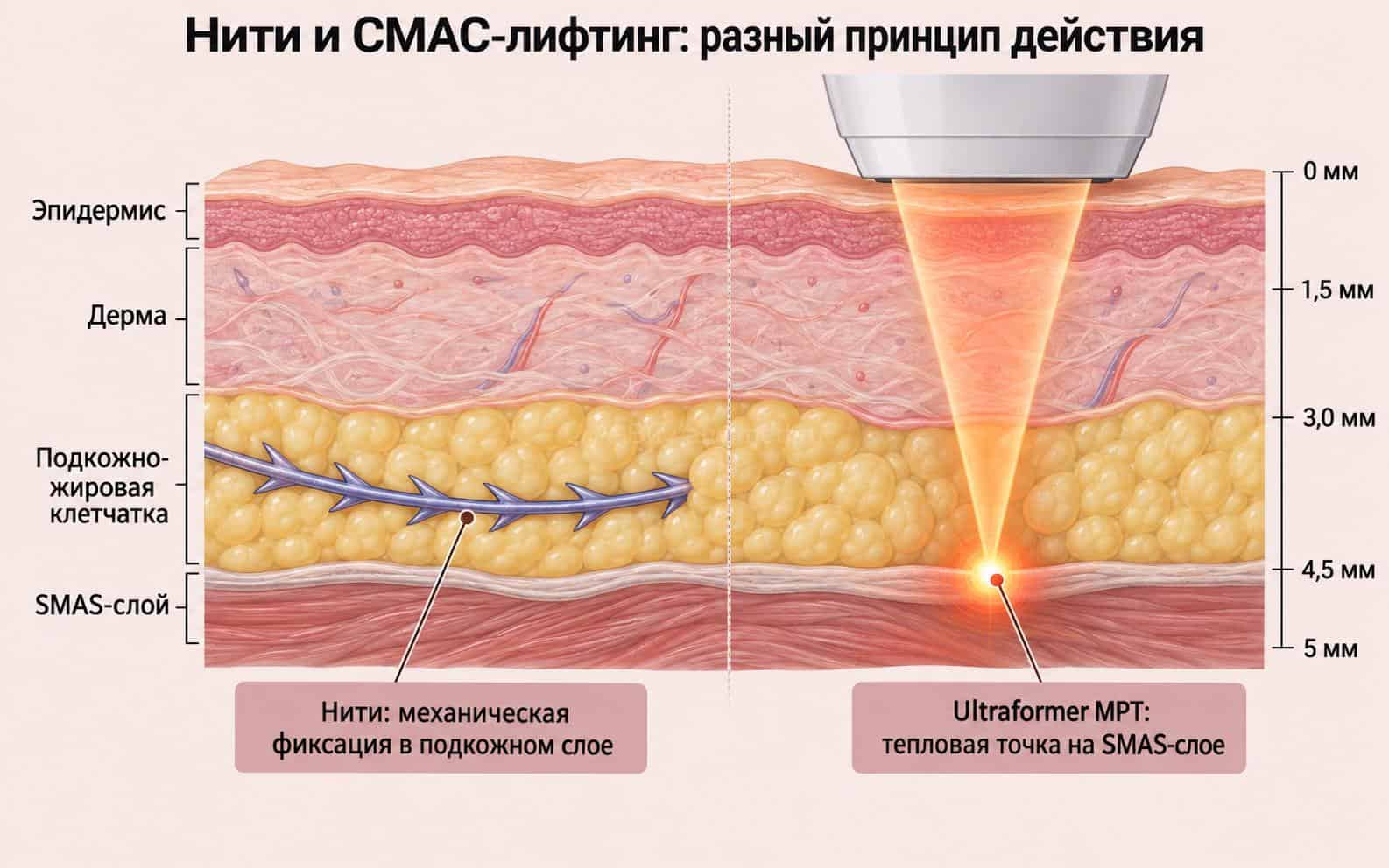 Схема сравнения нитей и СМАС-лифтинга: механическая фиксация нити в подкожном слое против тепловой точки Ultraformer MPT на SMAS-слое